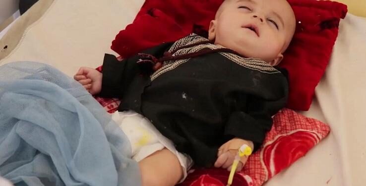 “افغانستان کې د نسناستي ناروغۍ پېښې کمې شوې”