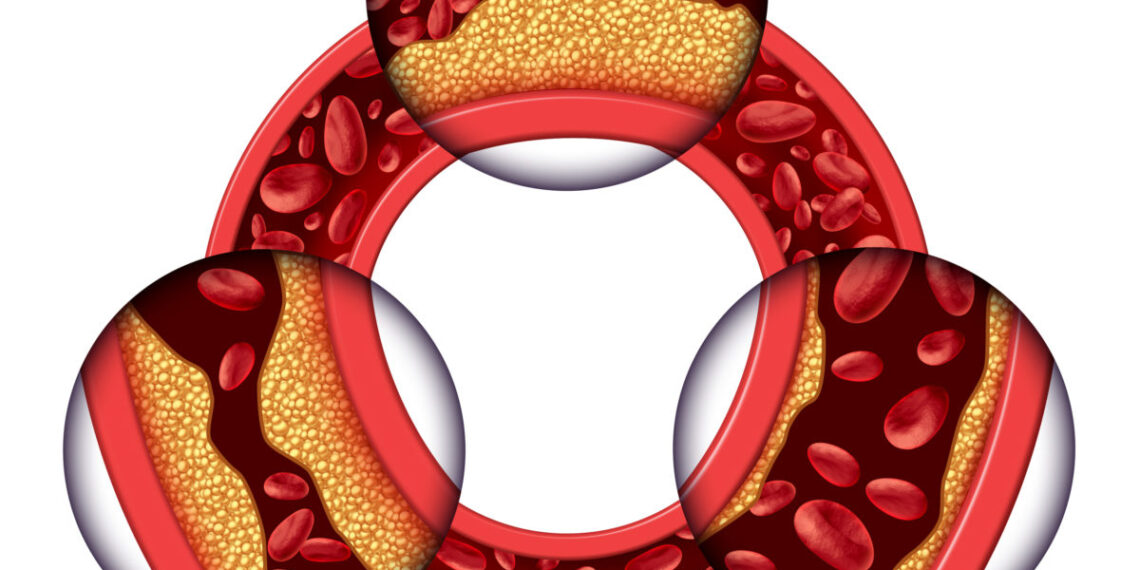لوړ کلسټرول؛ د درملنې او کنټرول لپاره يې څه بايد وشي؟